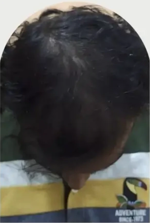 Male Pattern Baldness case 6 after treatment